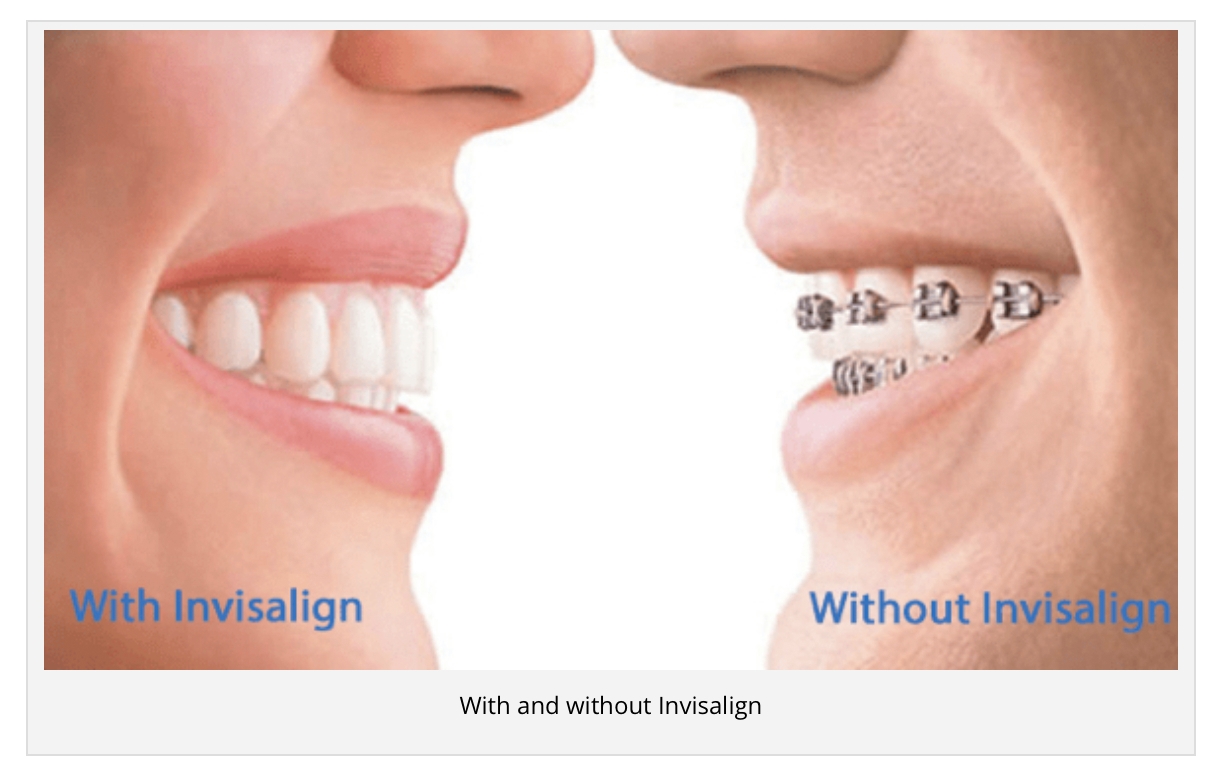 Get Your Invisalign Clear Braces at Our Ideal Smile Philadelphia Specialist