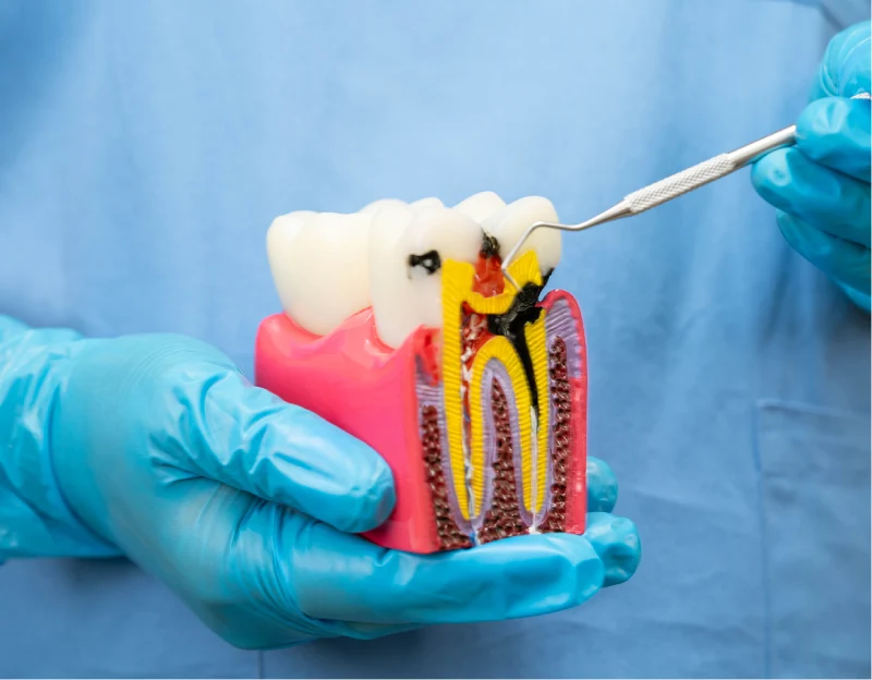 Ideal Smile Dental | What Happens During a Root Canal Procedure? A Step-by-Step Guide 
