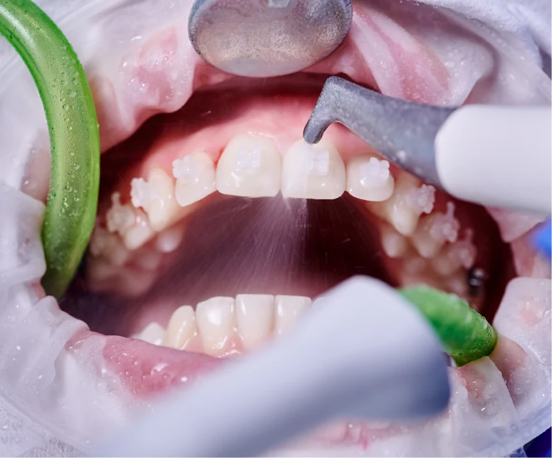 Ideal Smile Dental | Cleanings AKA Dental Prophylaxis