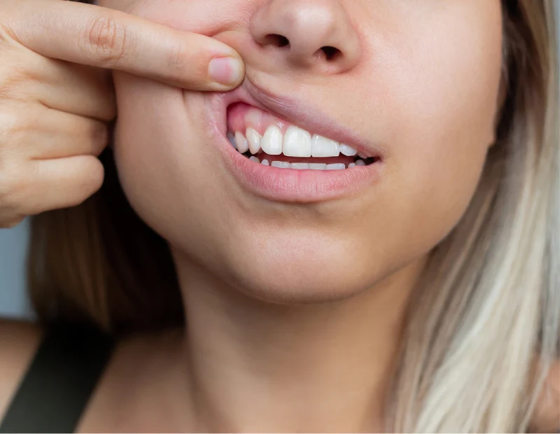 Ideal Smile Dental | Gum Contouring