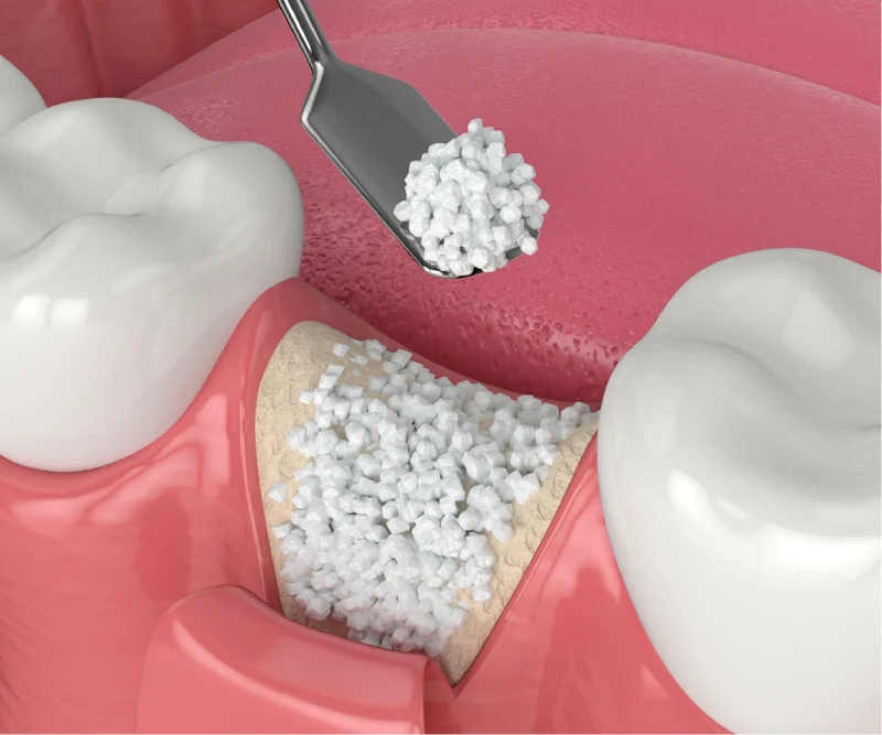 Ideal Smile Dental | Bone Grafts