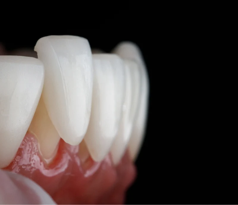 Ideal Smile Dental | Custom Porcelain Veneers