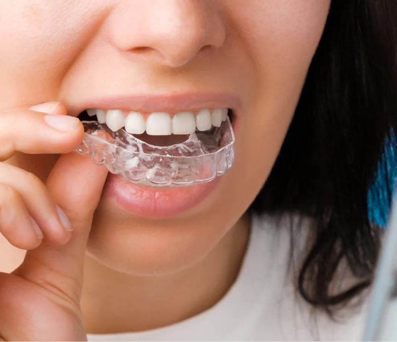 Ideal Smile Dental | Invisalign Clear Braces