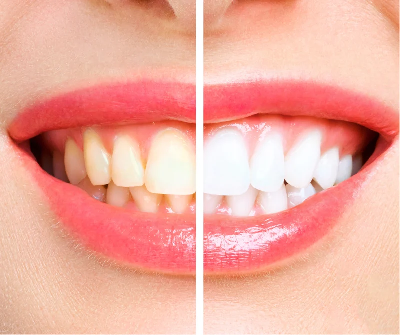 Ideal Smile Dental | Teeth Whitening